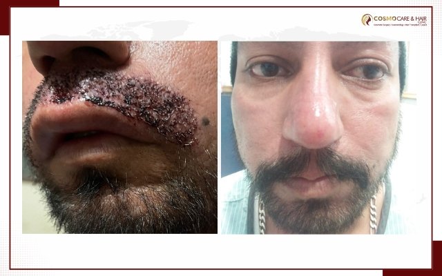 Moustache Hair Transplant