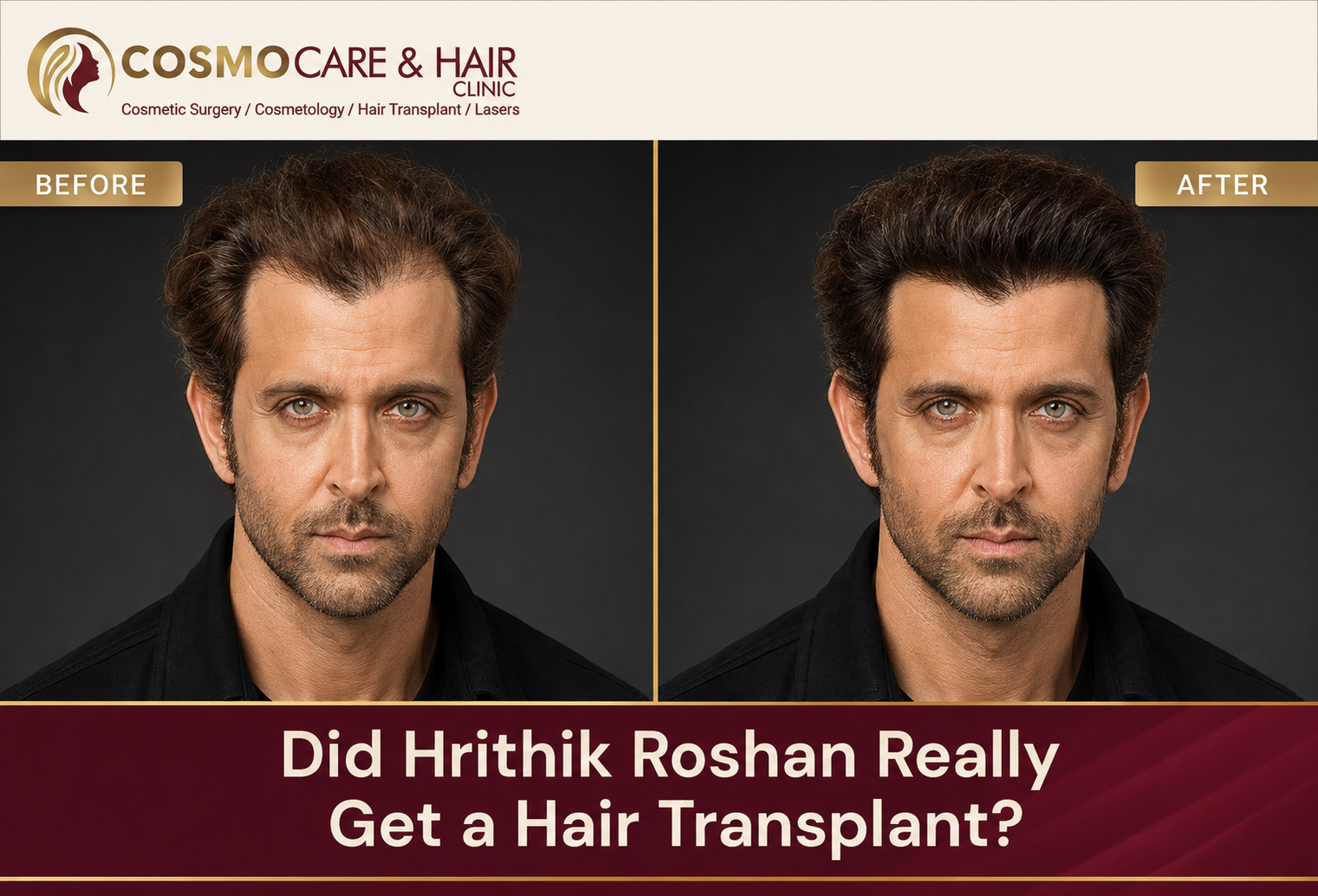Did Hrithik Roshan Really Get a Hair Transplant