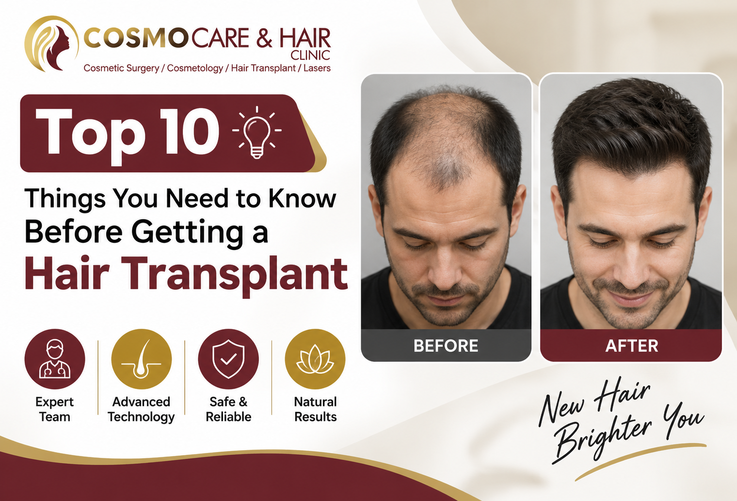 Top 10 Things You Need to Know Before Getting a Hair Transplant