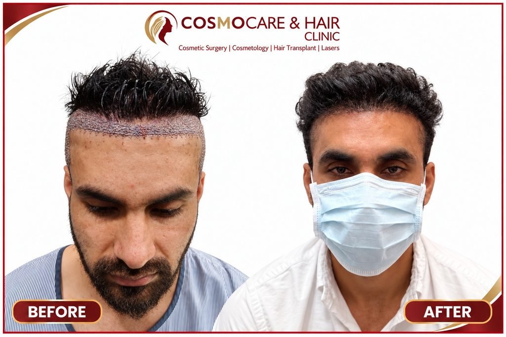 Hair Transplant Result Look Natural